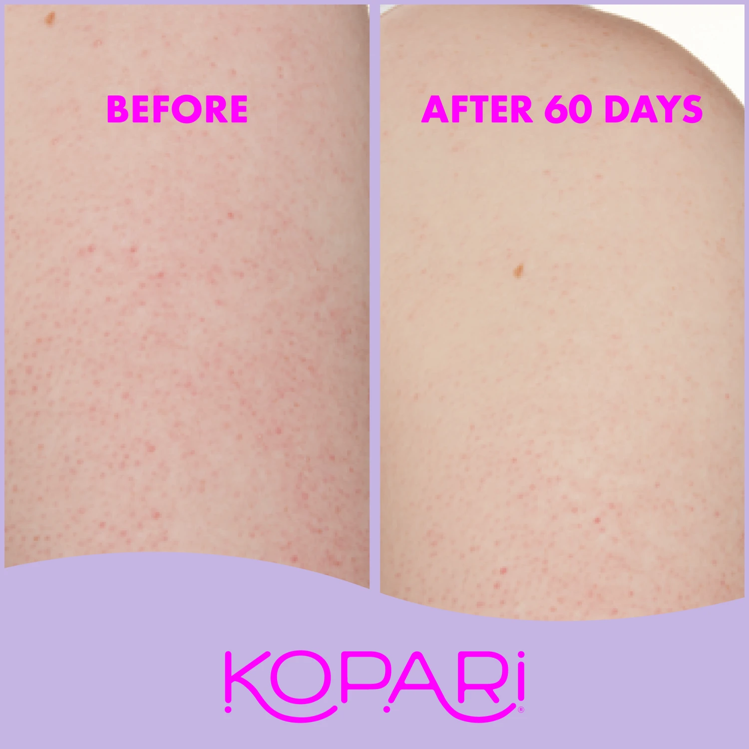 KP Body Bumps Be Gone Clarifying Body Scrub - Image 11