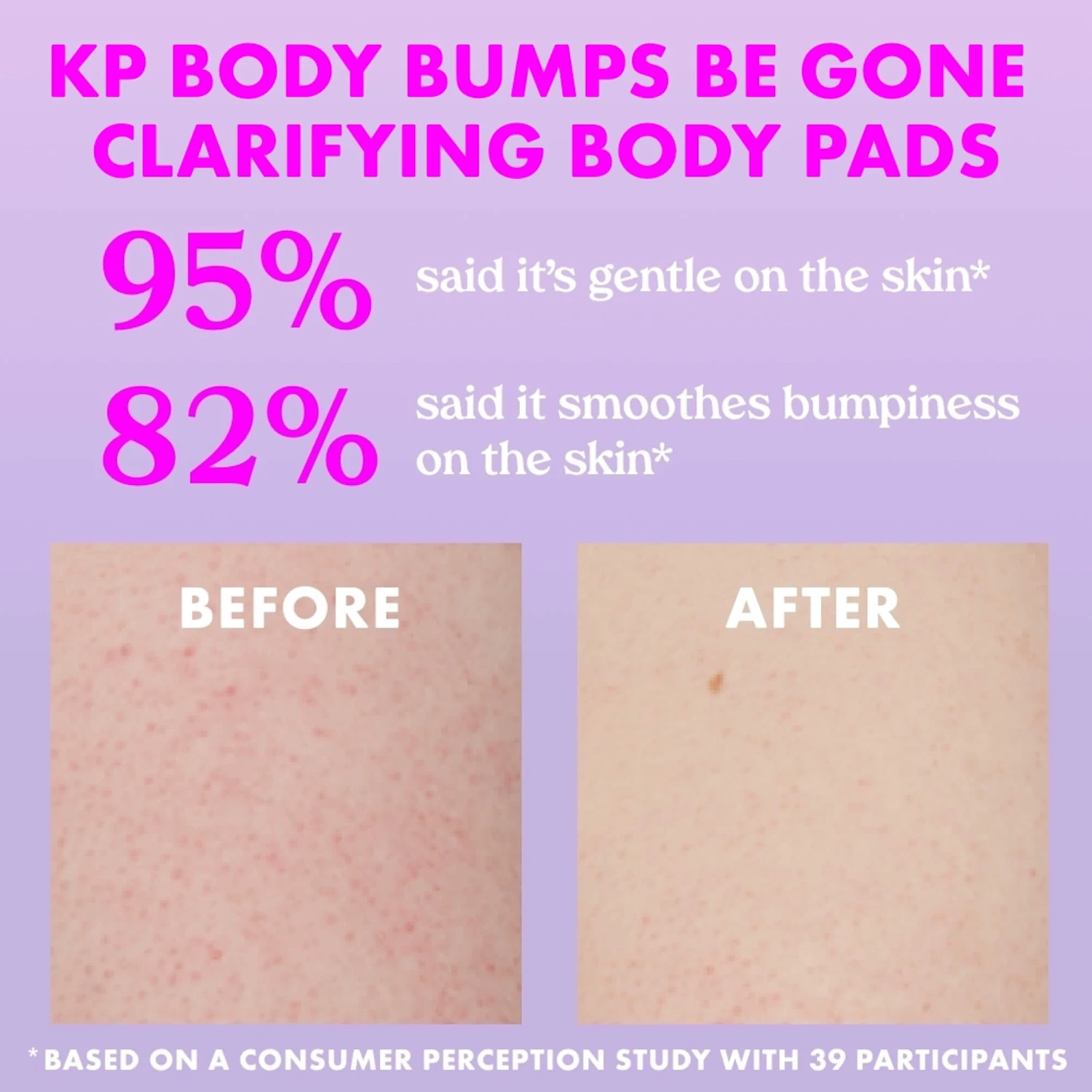 KP Body Bumps Be Gone Clarifying Body Pads - Image 5